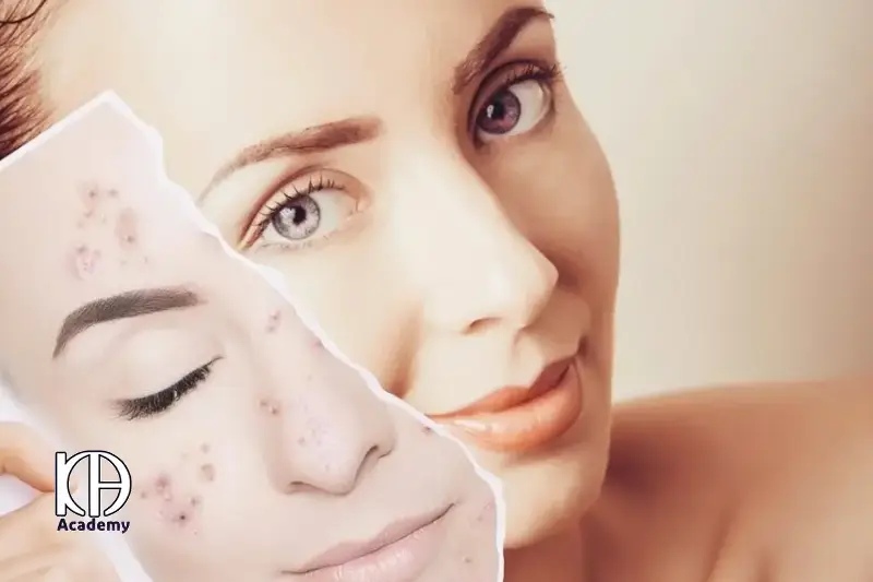 فیشیال ضد جوش و آکنه
