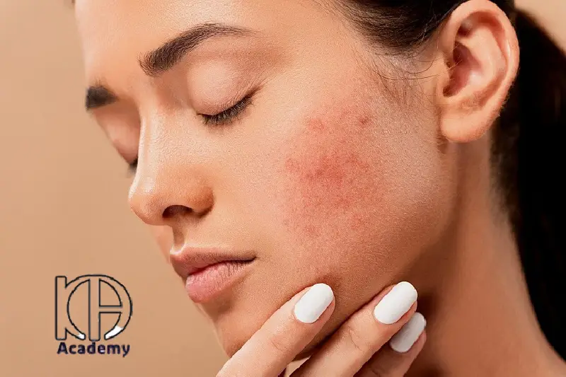 چرا بعد از فیشیال جوش میزنم؟ دلایل و راهکارهای پیشگیری جوش زدن بعد از فیشیال