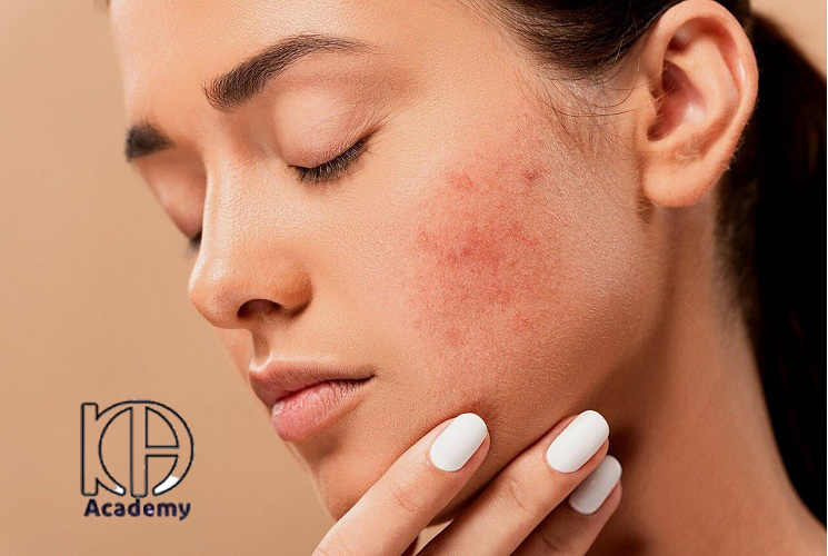 چرا بعد از فیشیال جوش می‌زنیم؟