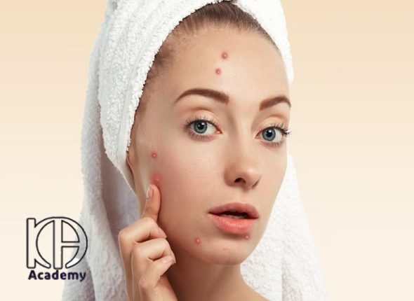 چرا بعد از فیشیال جوش می‌زنم؟ دلایل و راهکارهای پیشگیری جوش زدن بعد از فیشیال