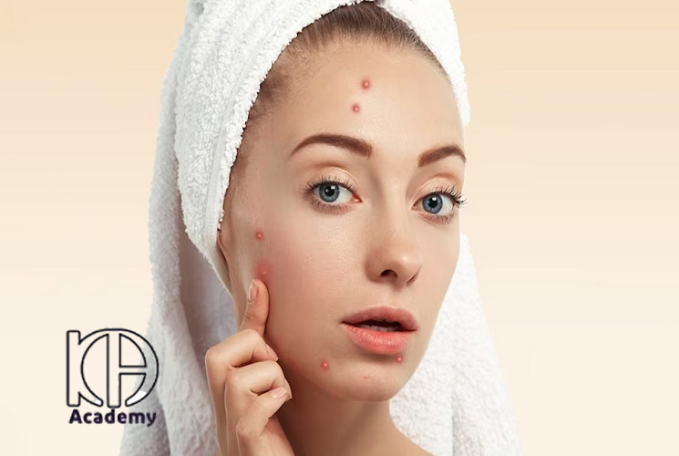 چرا بعد از فیشیال جوش می‌زنم؟ دلایل و راهکارهای پیشگیری جوش زدن بعد از فیشیال