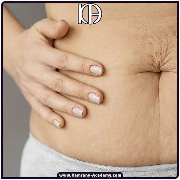 لیزر درکانی جای زخم