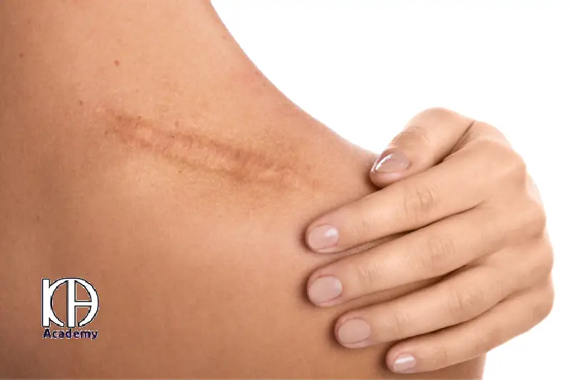 لیزر درمانی اسکار