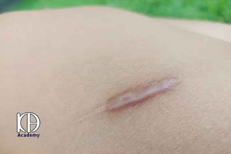 لیزر درمانی اسکار