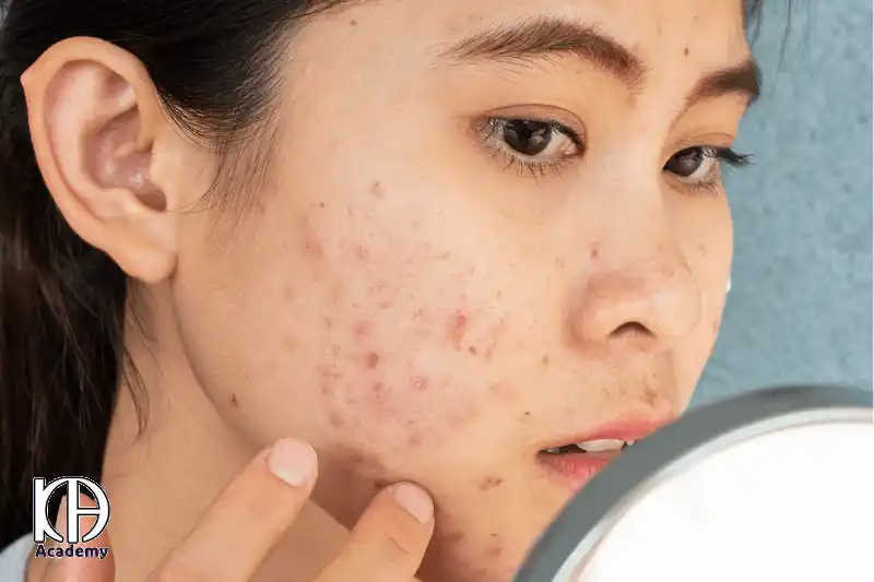 علائم آکنه چیست