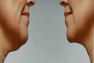 مزوتراپی غبغب چیست