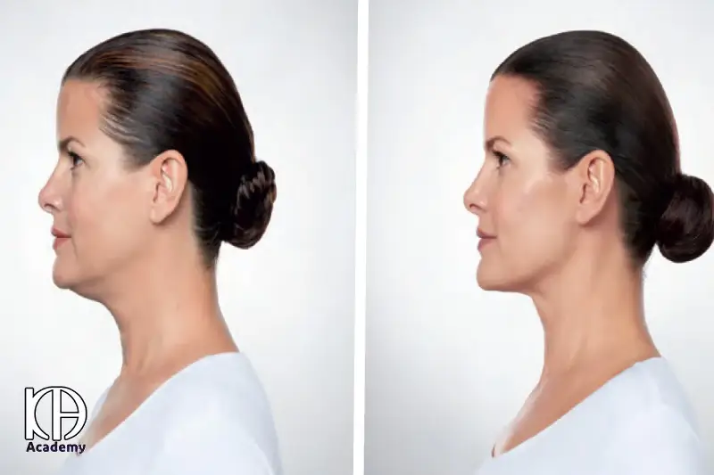 آیا مزوتراپی غبغب دائمی است