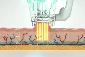 عوارض میکرونیدلینگ صورت چیست