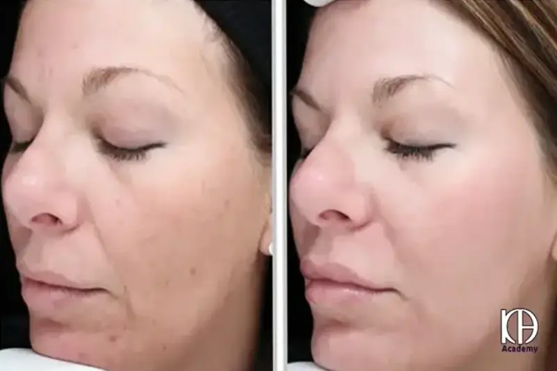 مراقبت های بعد از فیشیال