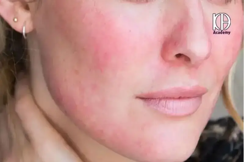 علائم هشداردهنده بعد از فیشال