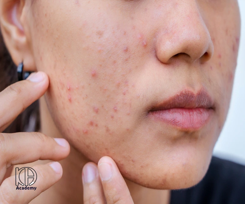 میکرونیدلینگ برای جاش جوش